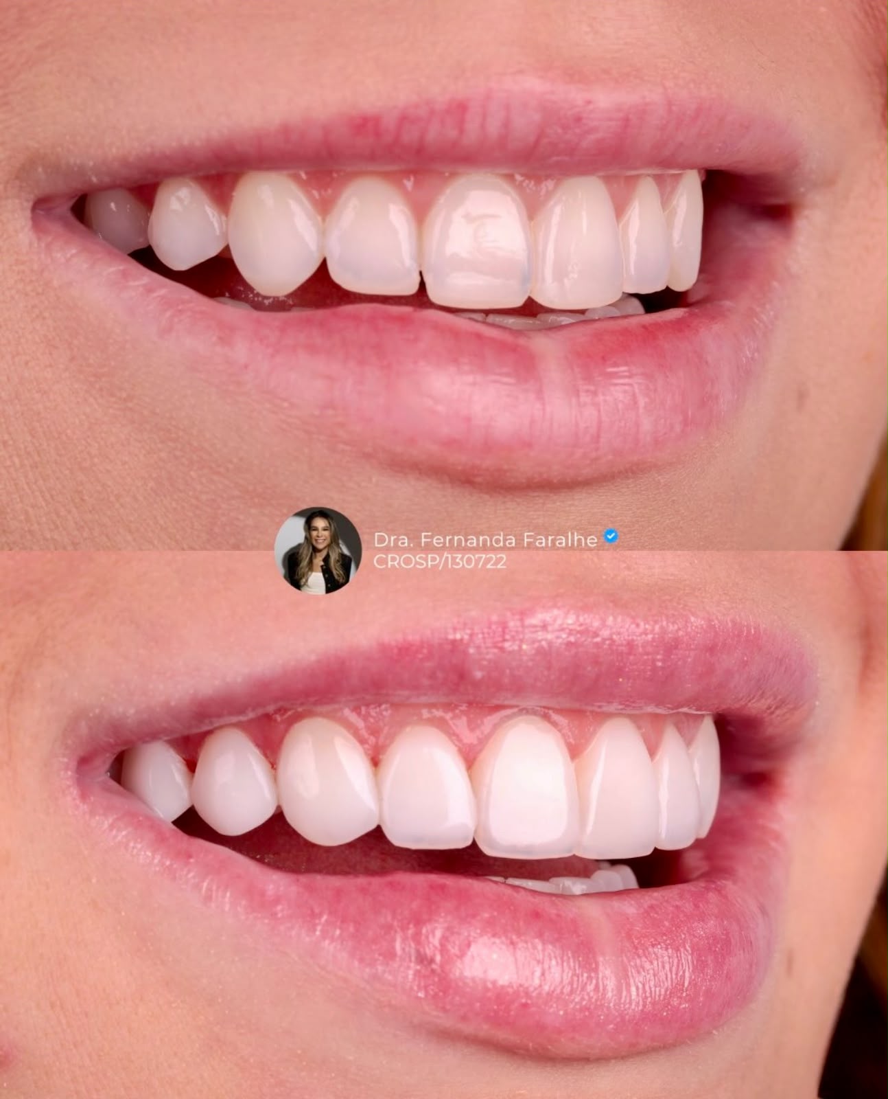 Antes e depois — Sorriso